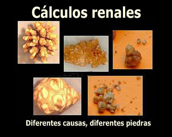dieta para piedras de calcio en el rinon dieta para piedras de calcio en el rinon